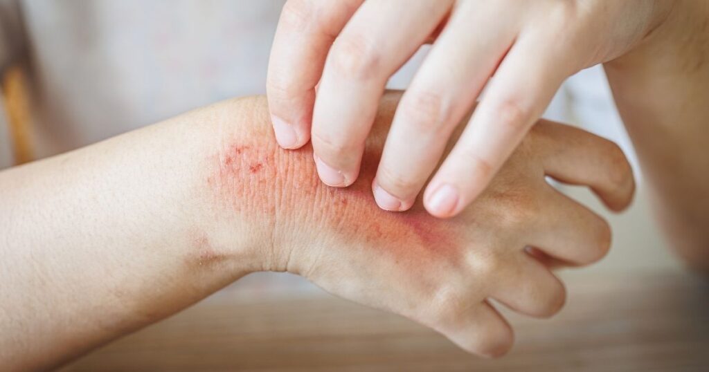 persona con enfermedad de la piel